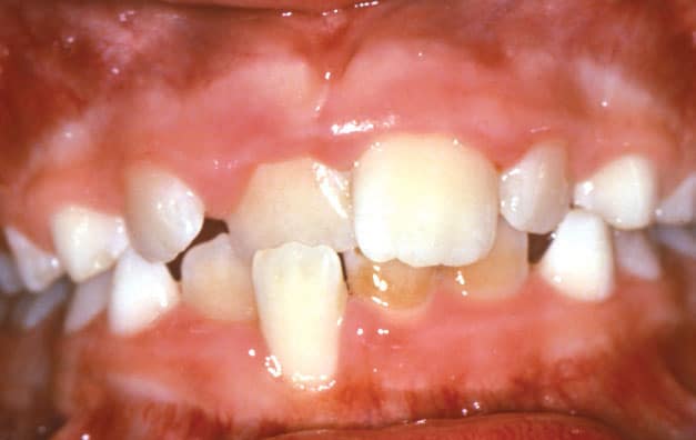 Crossbite Sprayberry Orthodontics in Auburn, AL