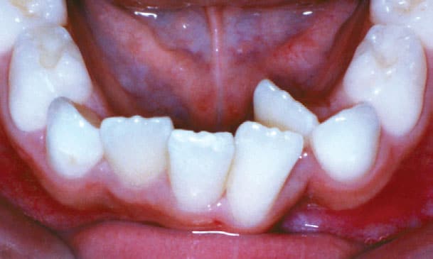 Crowding Sprayberry Orthodontics in Auburn, AL