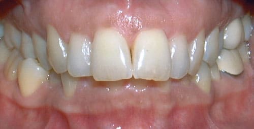 Overbite Sprayberry Orthodontics in Auburn, AL
