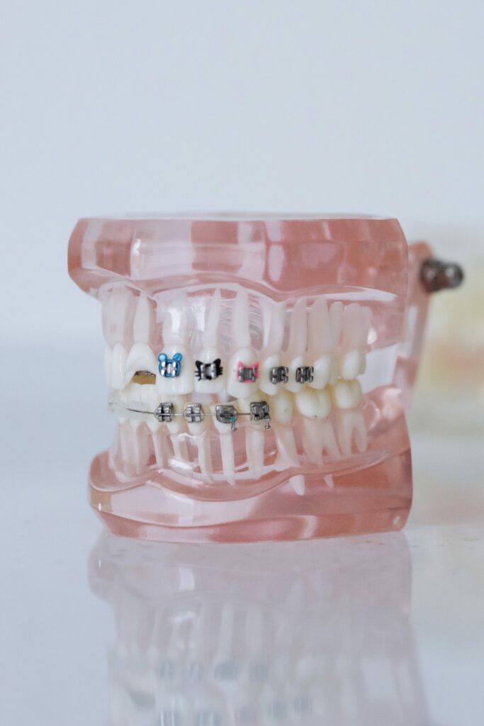 Elastics Braces Sprayberry Orthodontics in Auburn, AL