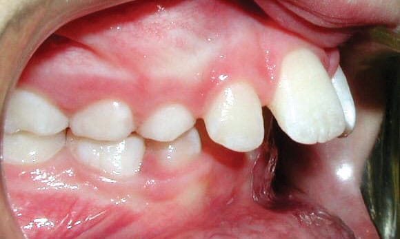 Protrusion Sprayberry Orthodontics in Auburn, AL