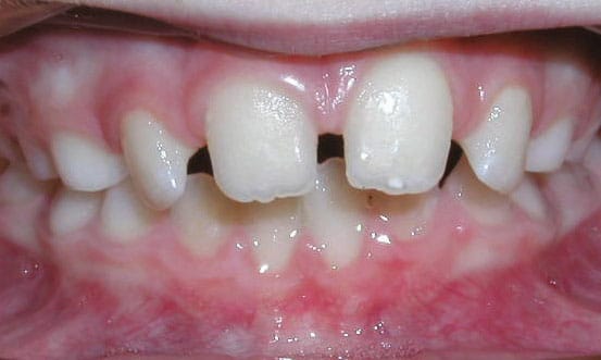 Spacing Sprayberry Orthodontics in Auburn, AL