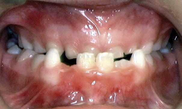 Underbite Sprayberry Orthodontics in Auburn, AL